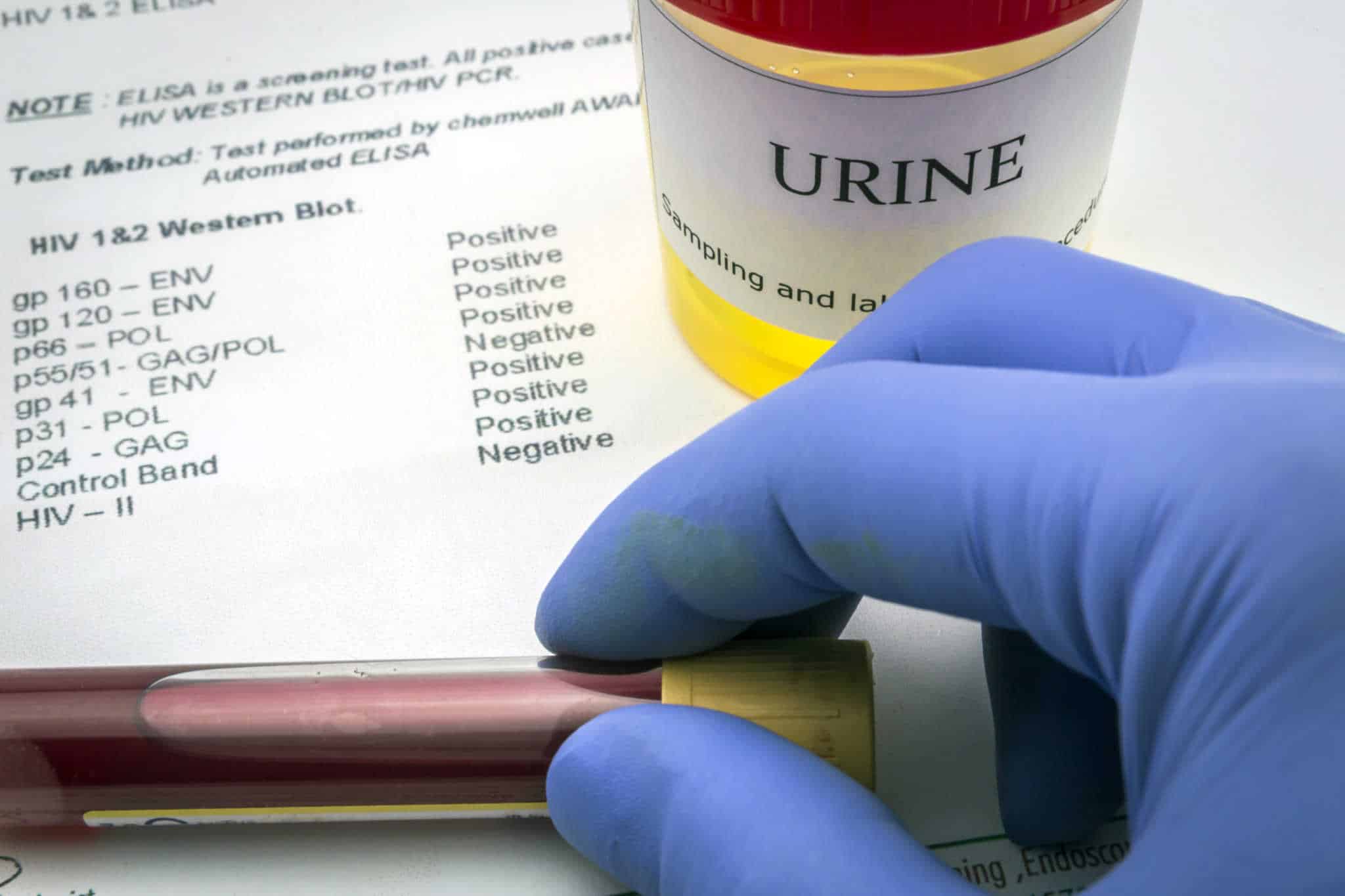 urine-culture-test-purpose-procedure-results