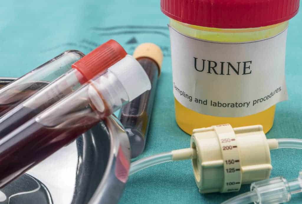 Urine samples on lab table